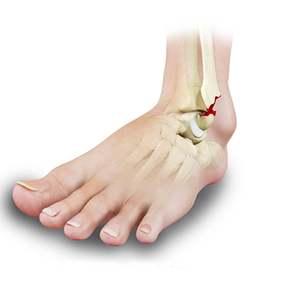 How do You Know if an Ankle is Broken or Sprained? - Dr. Naveen